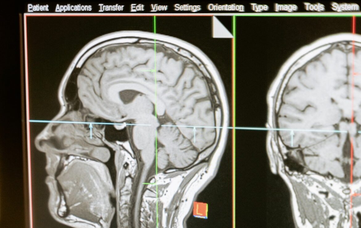 Az MR-diagnosztika jelentősége az idegrendszeri betegségek diagnosztizálásában
