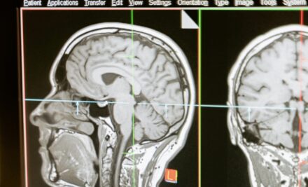 Az MR-diagnosztika jelentősége az idegrendszeri betegségek diagnosztizálásában